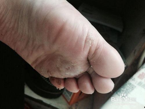 脚气水泡图片,“揭秘脚气水泡成因及防治策略”