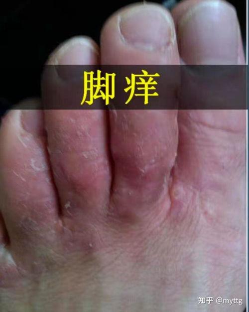 脚气水泡图片,“揭秘脚气水泡成因及防治策略”