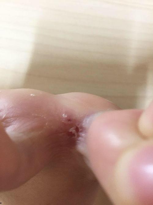 脚气水泡图片,“揭秘脚气水泡成因及防治策略”