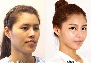 韩国整容图片,揭秘明星网红的蜕变之路