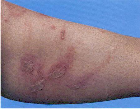 大腿皮炎图片大全,大腿皮炎症状解析与图片展示