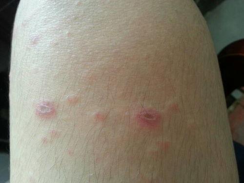 大腿皮炎图片大全,大腿皮炎症状解析与图片展示