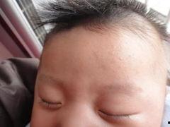 宝宝头部湿疹图片大全,症状识别与护理要点