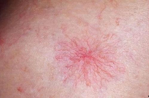 蜘蛛痣图片,揭秘其形态与成因