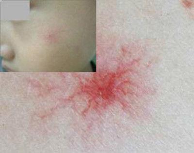 蜘蛛痣图片,揭秘其形态与成因