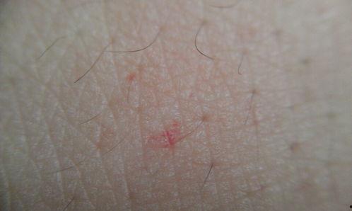 蜘蛛痣图片,揭秘其形态与成因